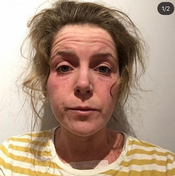 How cryotherapy has changed the lives of Topical steroid withdrawal ...